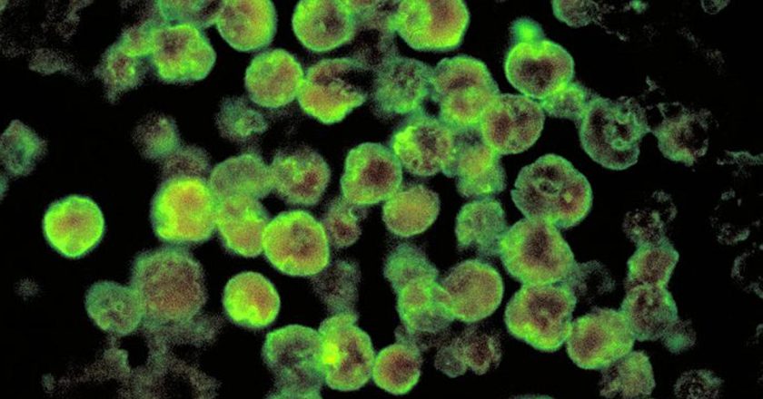 Rare case of brain-eating amoeba confirmed in Florida – CBS News