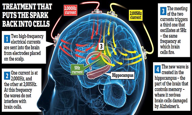 Alzheimers zapped: Scientist launch landmark trial to treat dementia – Daily Mail