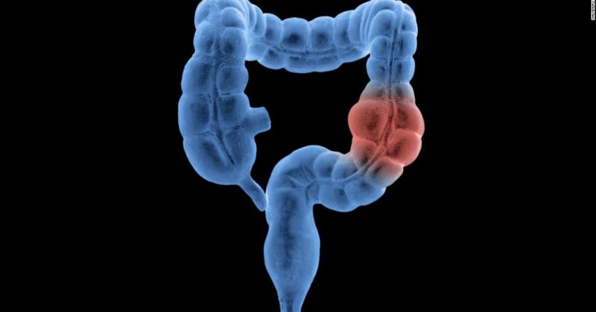 Colon and rectal cancer cases are going up among people younger than age 50, researchers say – CNN