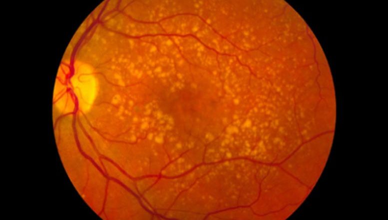 Ancient Part of Immune System May Underpin Severe COVID-19 – Key May Be in Your Eyes – SciTechDaily