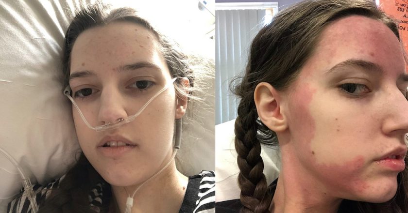 Woman becomes allergic to all food and has to be fed through her heart – Yahoo Lifestyle