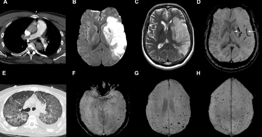 Its not just the lungs: How COVID-19 attacks the brain – New York Post