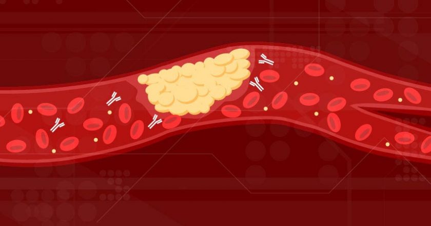 Autoantibodies Causing COVID-19 Blood Clots That Wreak Havoc on Patients – SciTechDaily