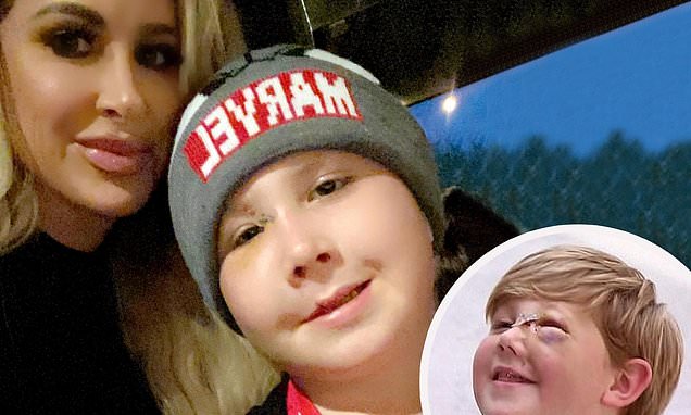 Kim Zolciak reveals son Kash, 8, had facial reconstructive surgery three years after dog bit face – Daily Mail