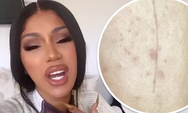 Cardi B asks Twitter for help with blackheads on her cheek and chin: S*** is uncomfortable! – Daily Mail