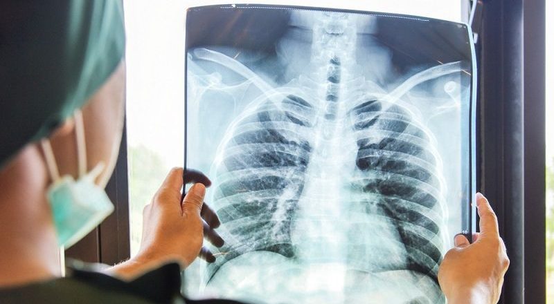 A woman seemed recovered from COVID-19. Then both her lungs collapsed. – Livescience.com