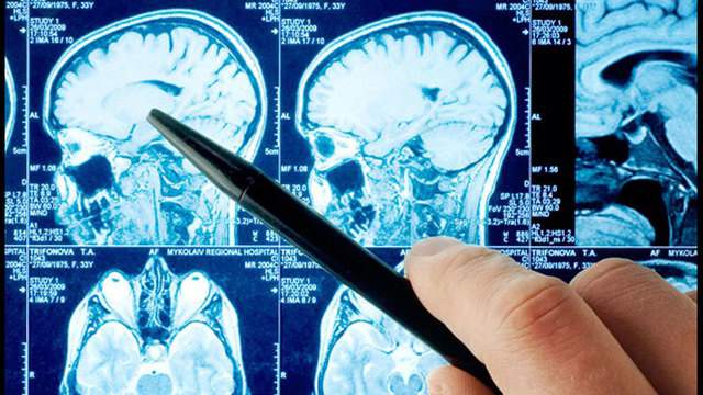 COVID-19 likely to impact the brain, San Antonio researchers find – KSAT San Antonio