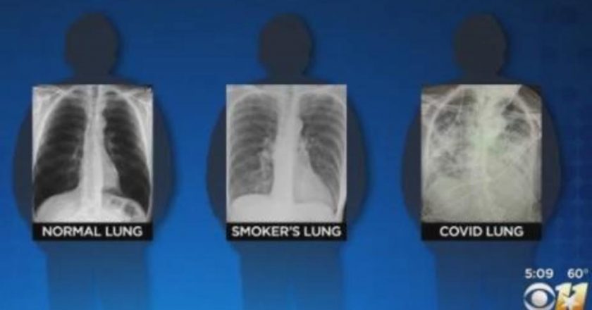 Post-COVID lungs worse than the worst smokers lungs, surgeon says – CBS News