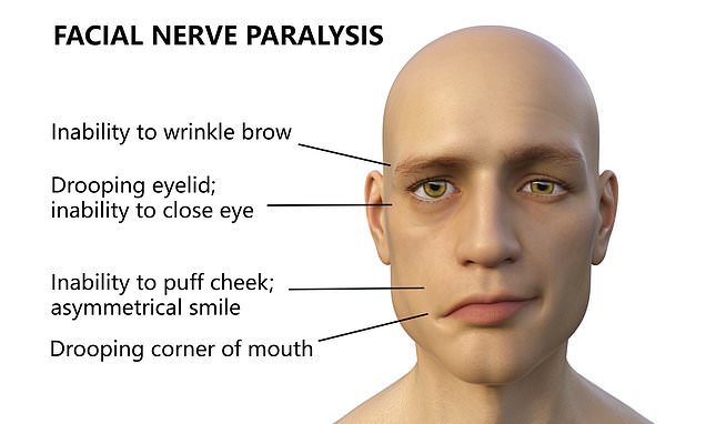 Patients with COVID-19 are SEVEN TIMES more likely to have Bells palsy than vaccine recipients – Daily Mail