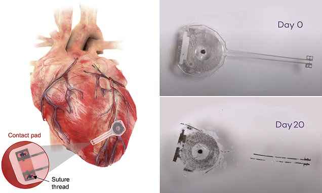 Worlds first wireless, battery-free, fully implantable pacemaker DISSOLVES within seven weeks – Daily Mail