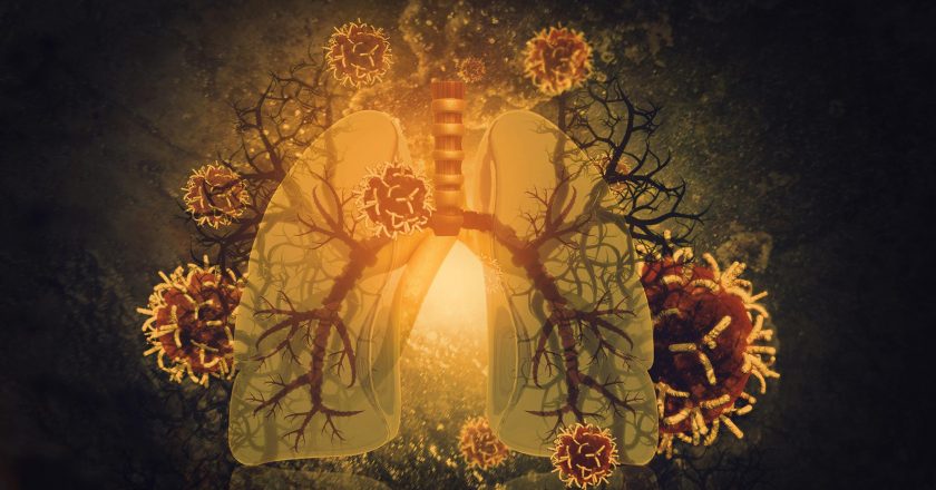 Scientists Discover Exactly How COVID-19 Wreaks Havoc on Human Lungs – SciTechDaily