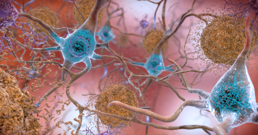 Scientists Find Unusual Form of Iron and Copper in Brains of Alzheimers Patients – Gizmodo