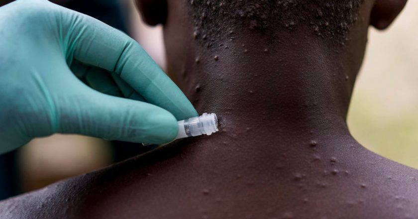 Monkeypox virus reported in a person who flew from Nigeria to Dallas through Atlanta – The Washington Post