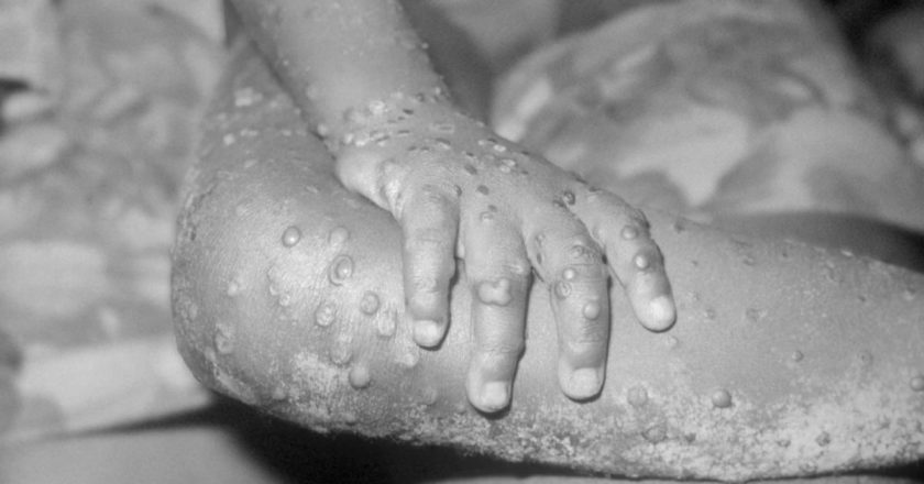 Texas patient becomes U.S. first monkeypox case since 2003 – CBS News