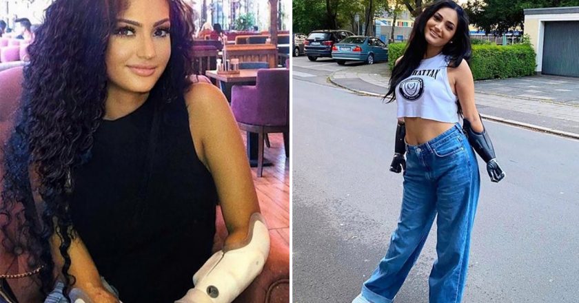 Woman awaits dream double-arm transplant after losing all four limbs – New York Post