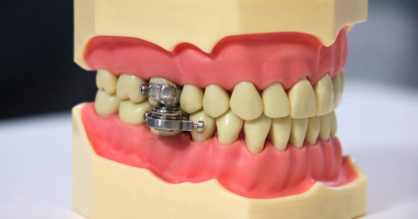 Terrifying Magnetic Mouth Clamp is Actually a Cheaper and Safer Alternative to Weight Loss Surgery – Gizmodo