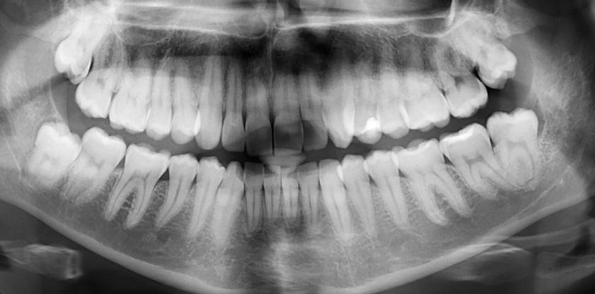 Ingeniously Simple Dental Treatment Could Heal Tooth Cavities Without Any Fillings – ScienceAlert