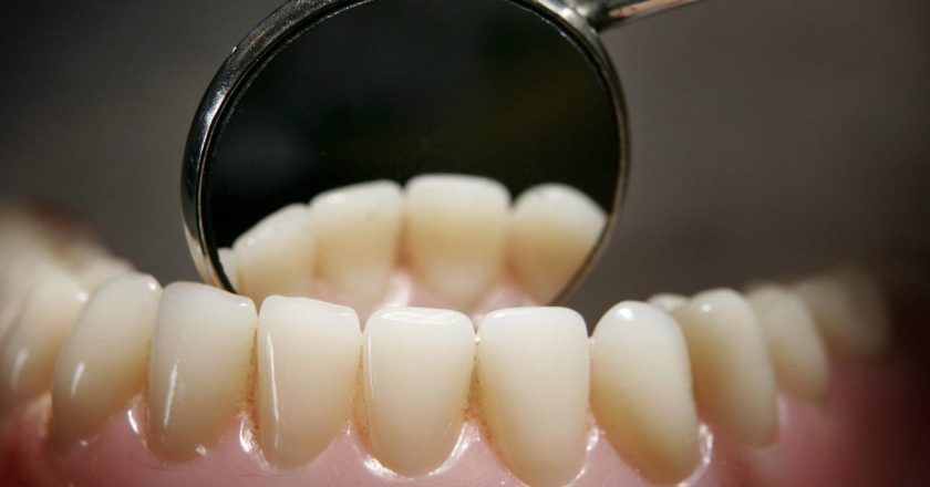 The More Teeth You Lose, the Greater Your Dementia Risk, Study Suggests – Gizmodo