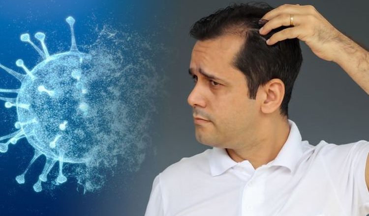 People experiencing hair loss months after a Covid infection – surge in cases warns doctor – Express