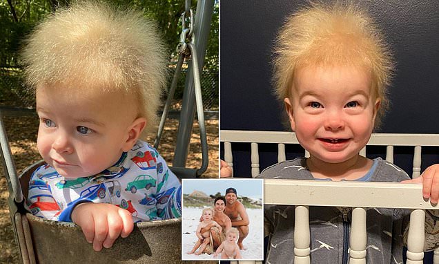 One-year-old with rare uncombable hair syndrome – Daily Mail