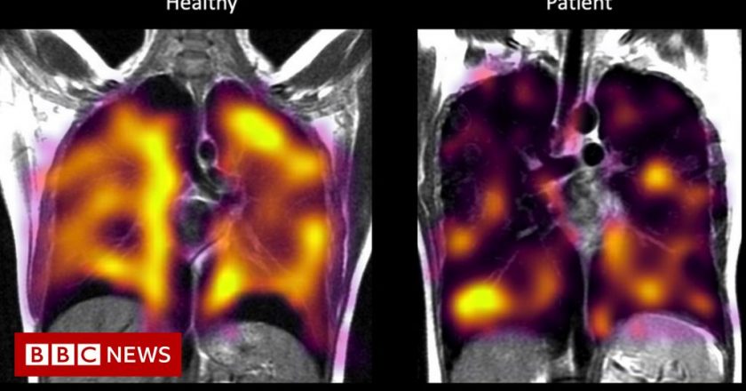 Long Covid: Hidden lung damage spotted on scans – BBC News