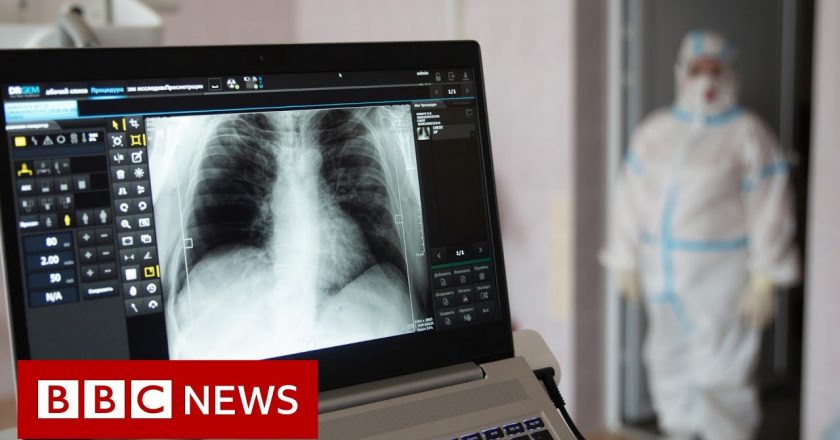 Some long Covid patients may have hidden damage to their lungs – BBC News – BBC News