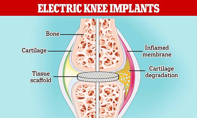 Scientists regrow knee cartilage with an electric current – Daily Mail