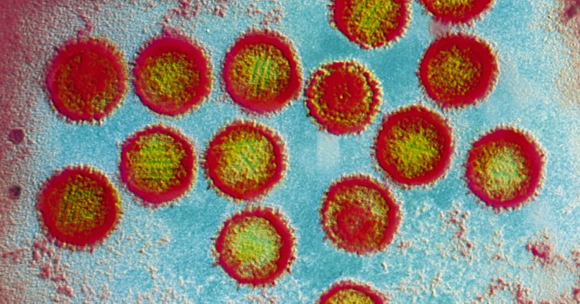 Epstein-Barr Virus May Play Role in Multiple Sclerosis Development – The New York Times