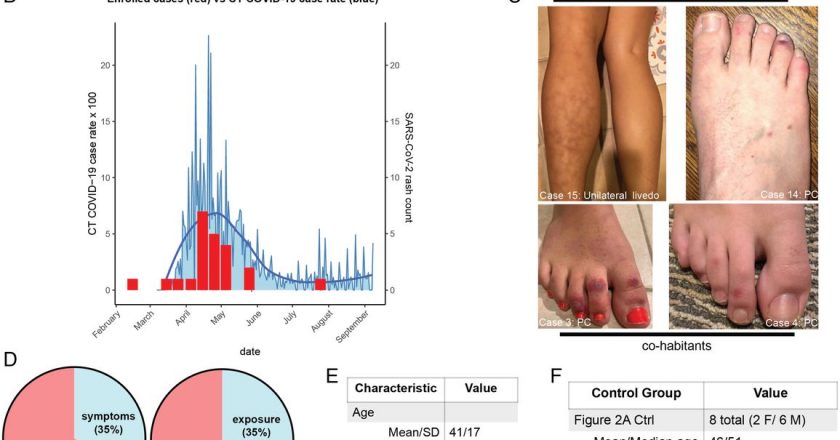 Lack of association between pandemic chilblains and SARS-CoV-2 infection – pnas.org