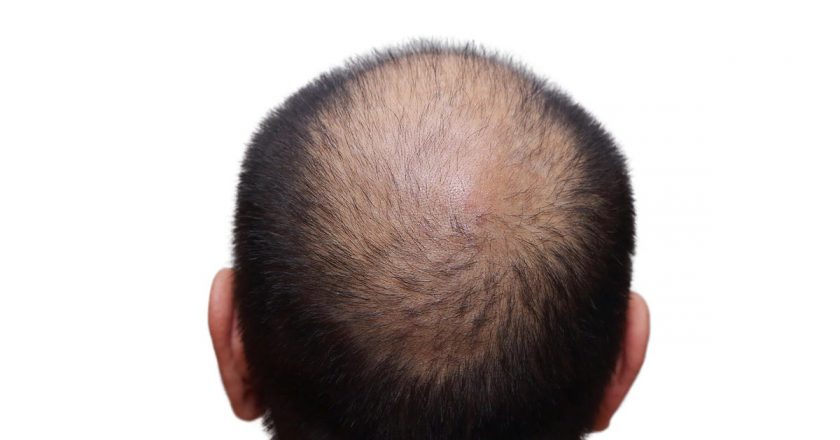 Boomer Health: New study details most effective options for male pattern baldness – Palm Beach Post