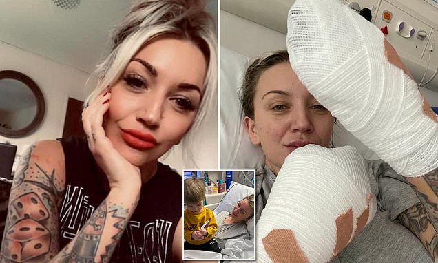 Peterborough woman 34, had to have ALL her fingers amputated after kidney stone agony led to sepsis – Daily Mail