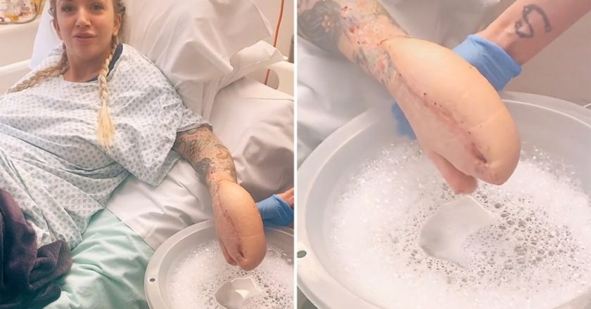 Woman left with shark hand after doctors sew it inside stomach during surgery – New York Post