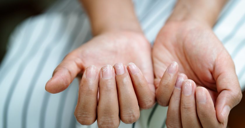 If You Notice This About Your Fingers, Youre at Risk for Severe COVID – Best Life