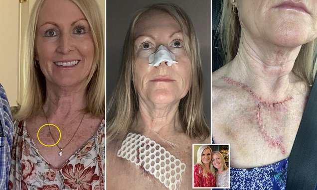 Mother, 62, says suspicious chest mark turned out to be cancerous – Daily Mail