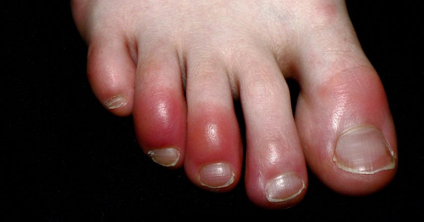 Mysterious wave of COVID toes still has scientists stumped – National Geographic