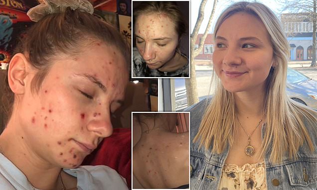 Young woman spent years hiding face after daily skin picking sessions – Daily Mail