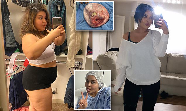 Nurse, 28, discovers she was growing a 20LB tumor filled with HAIR AND TEETH – Daily Mail