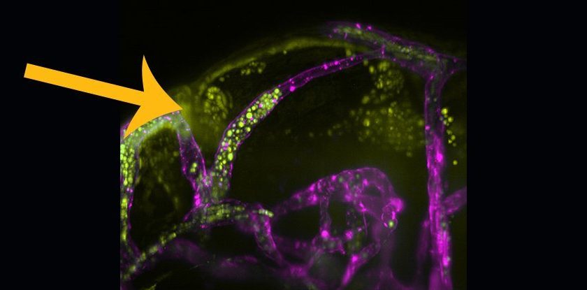 We Finally Know How Deadly Fungal Meningitis Spreads in The Brain, And Its Brutal – ScienceAlert