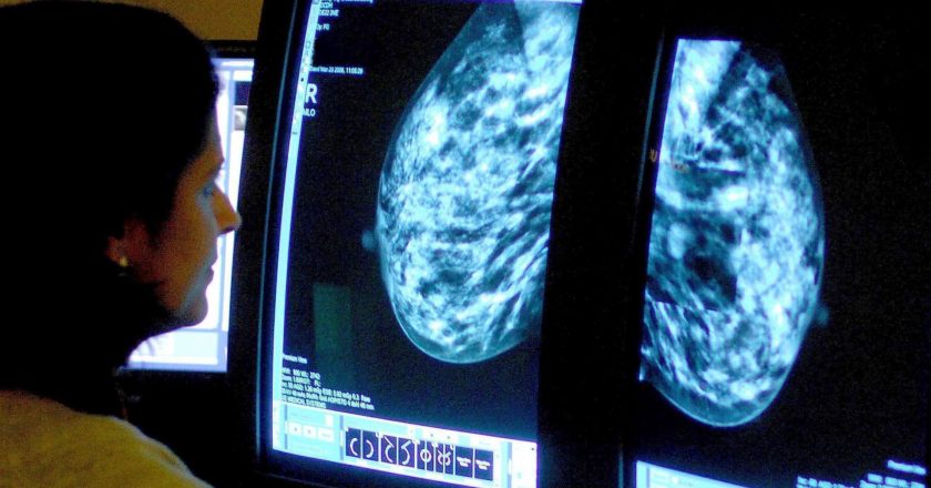 Scientists shed new light on how early stage breast cancer spreads to other organs – CNBC