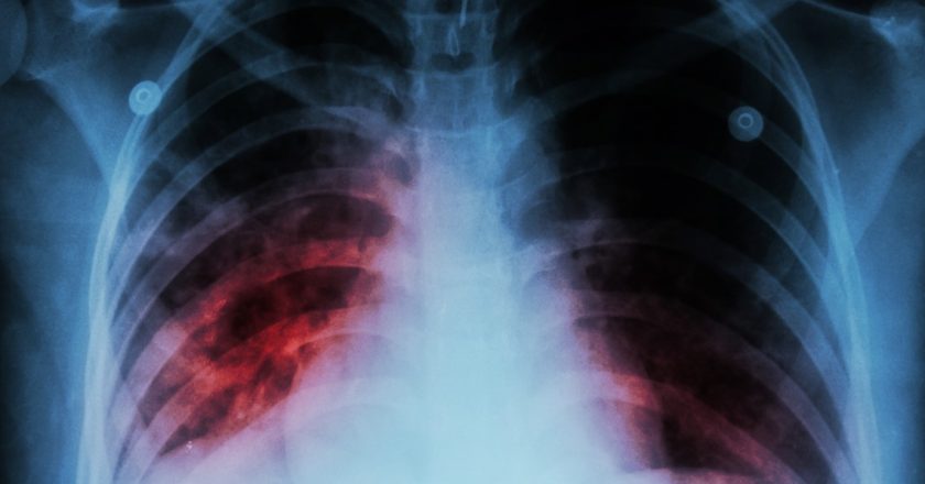 Washington experiencing largest tuberculosis outbreak in 20 years – KING5.com