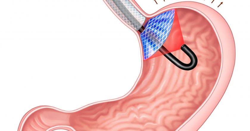 Nonsurgical Implant Could Help Overcome Obesity by Killing Cells Producing Ghrelin, the “Hunger Hormone” – SciTechDaily