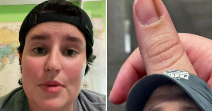 Signs and symptoms of subungual melanoma by US woman who noticed a ‘cool streak’ under her thumbnail for 10 years – 7NEWS