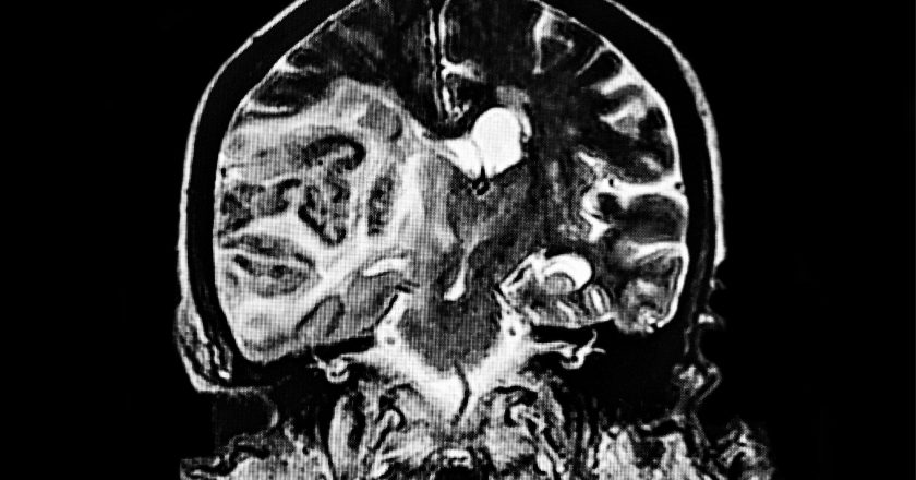 COVID-19’s Severe Impacts on the Brain – Even in People That Did Not Experience Serious Respiratory Symptoms – SciTechDaily