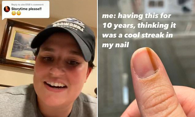 Woman who lived with a cool streak under her thumbnail for nearly 10 years reveals it is cancer – Daily Mail