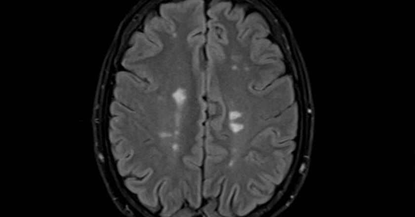 Promising Data Suggests New Multiple Sclerosis Therapy Could Halt or Reverse Symptoms – Gizmodo