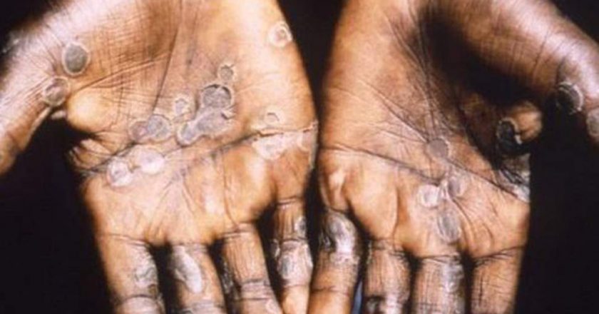 UK confirms more cases of monkeypox – Fox News