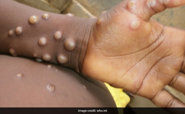 Spain, Portugal Detect Over 40 Suspected Cases Of Rare Monkeypox Disease – NDTV