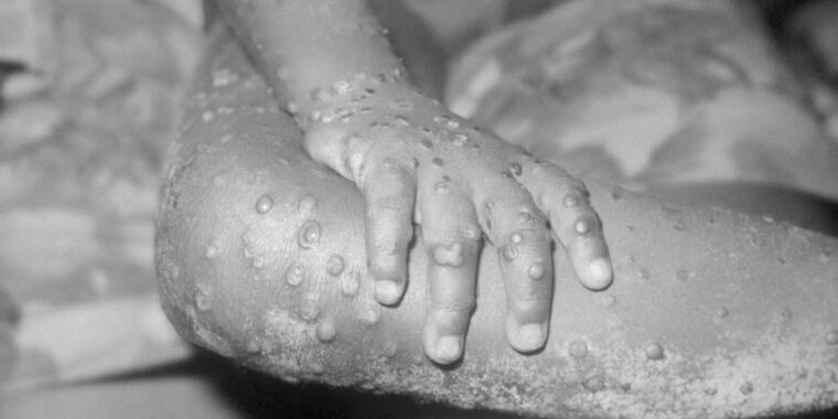 Monkeypox outbreak erupts; US, UK, Spain, Portugal, and more report cases – Ars Technica