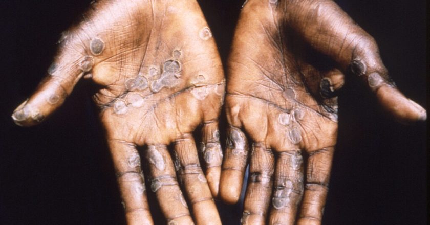 A CDC expert answers questions on monkeypox – STAT