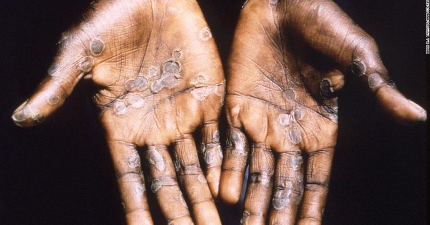 What is monkeypox and its signs and symptoms? – CNN